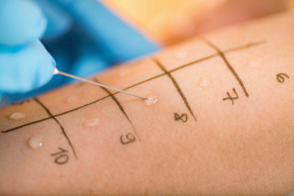 Hausstauballergie-Test mit einem Haut-Pricktest. mit einer Tropfpipette Lösungen in einem Abstand von ca. 4 cm auf die Haut getropft, als Testareal dient dafür der Unterarm.