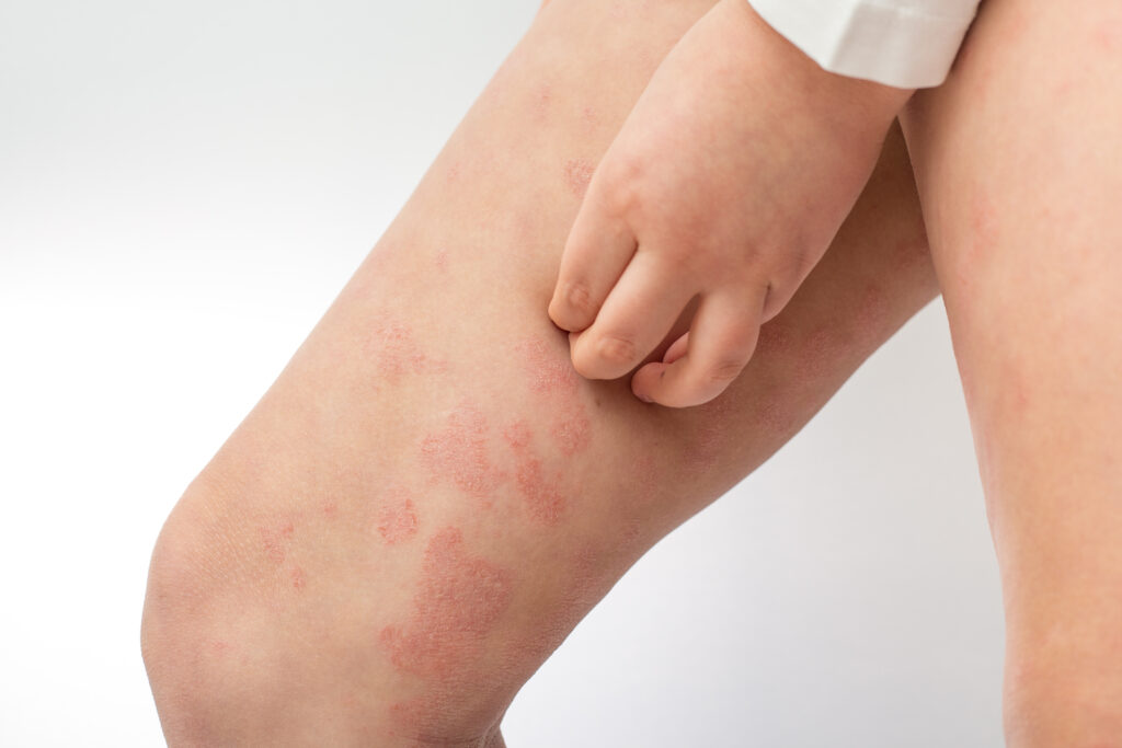 Atopische Dermatitis am Bein