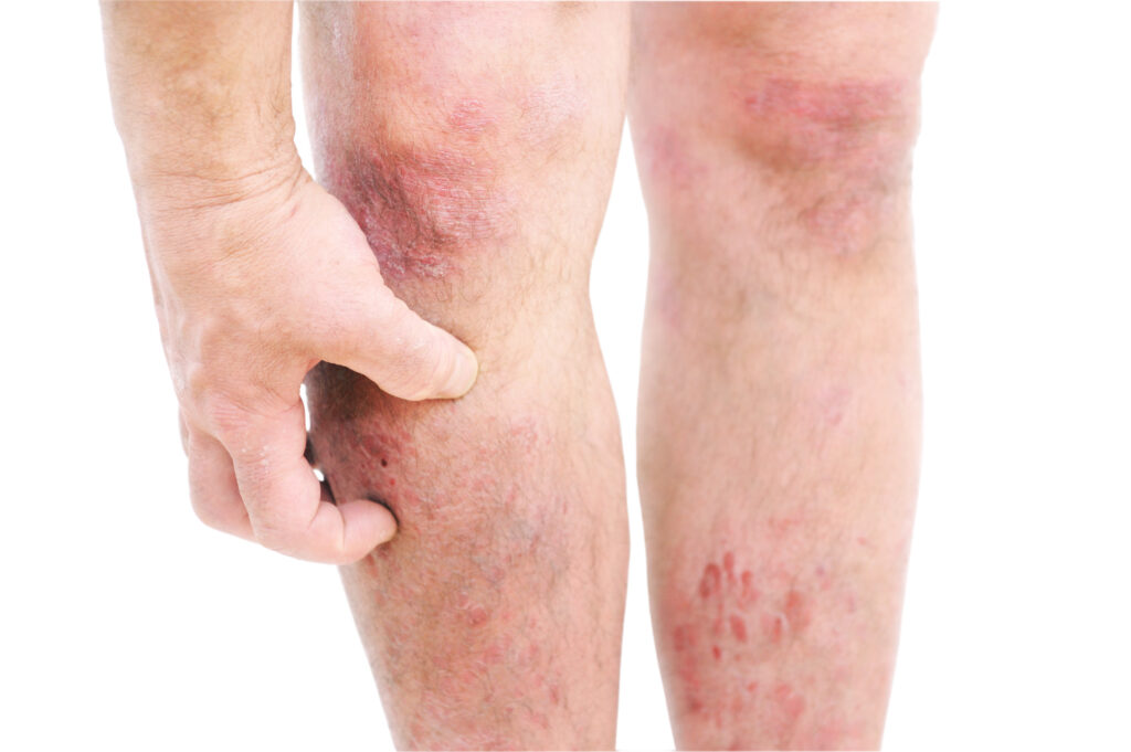 Atopische Dermatitis Atopisches Ekzem Mann kratzt am Bein
