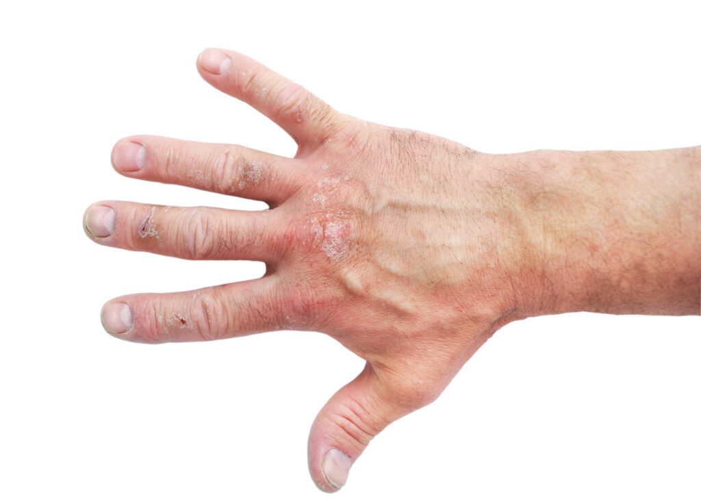 Atopische Dermatitis Atopisches Ekzem an der Hand