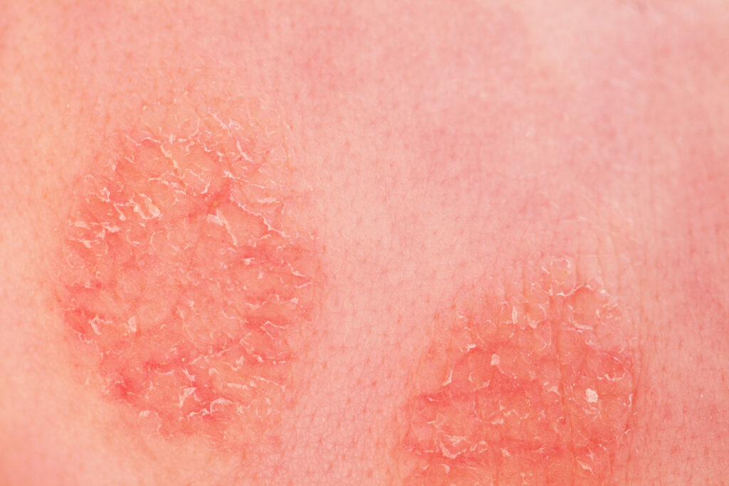 Atopische Dermatitis Atopisches Ekzem Haut