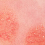 Atopische Dermatitis Atopisches Ekzem Haut