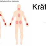 krätzmilben – krätzmilben Krätzmilben Bild Schaubild