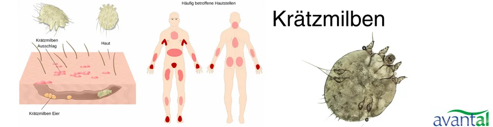 Krätzmilben Bild Schaubild Krätzmilben Bild Schaubild