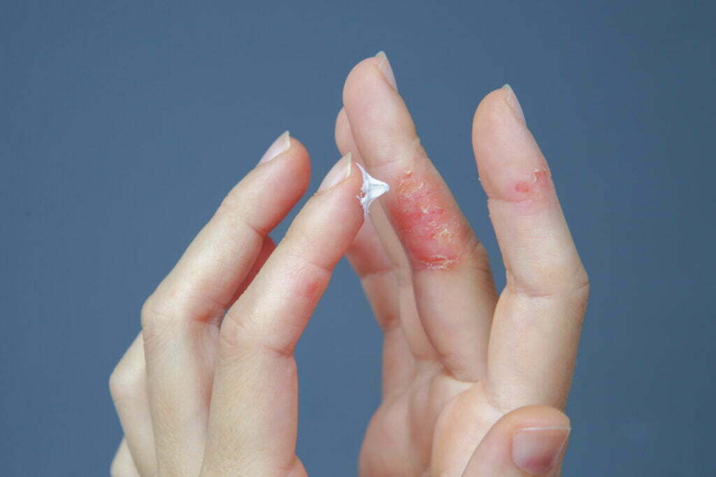 Neurodermitis-Behandlung an den Fingern