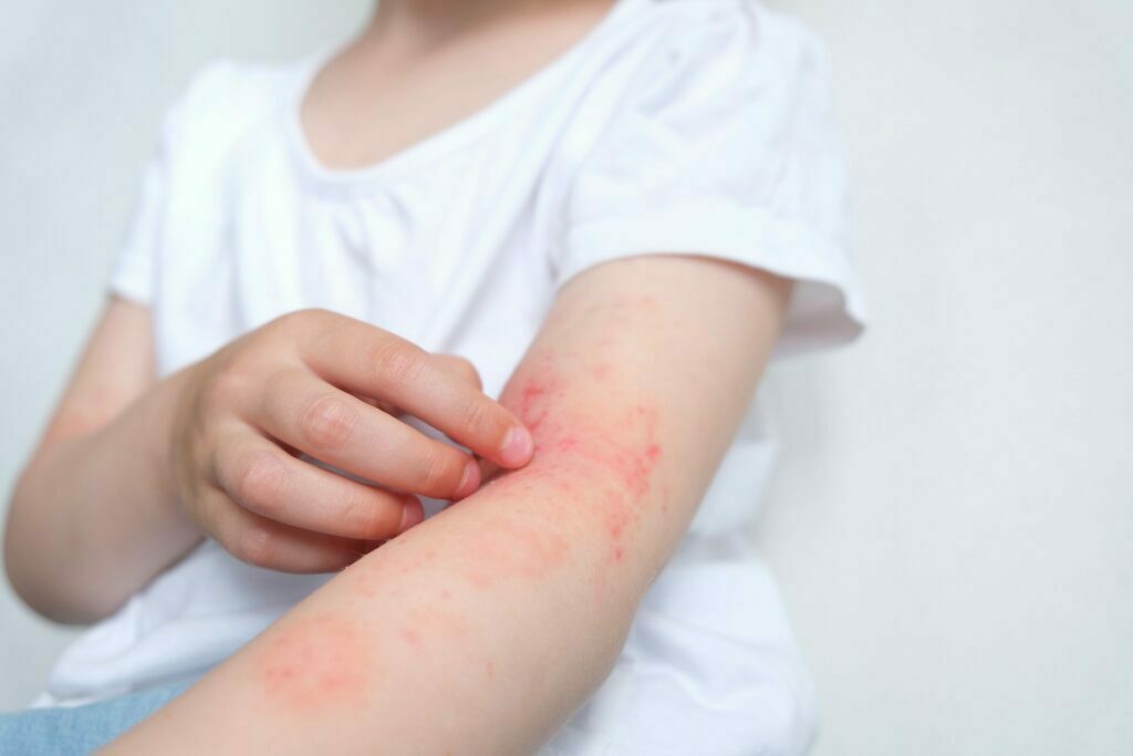 Neurodermitis Kind kratzt sich am Arm