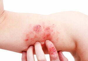Neurodermitis am Arm zeigt starke Rötung der Haut, Krusten- und Schuppenbildung. Neurodermitis Juckreiz lindern