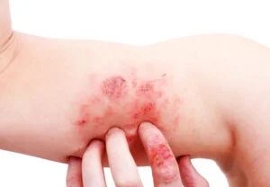 Neurodermitis Juckreiz lindern – Neurodermitis Juckreiz lindern Neurodermitis am Arm zeigt starke Rötung der Haut, Krusten- und Schuppenbildung. Neurodermitis Juckreiz lindern
