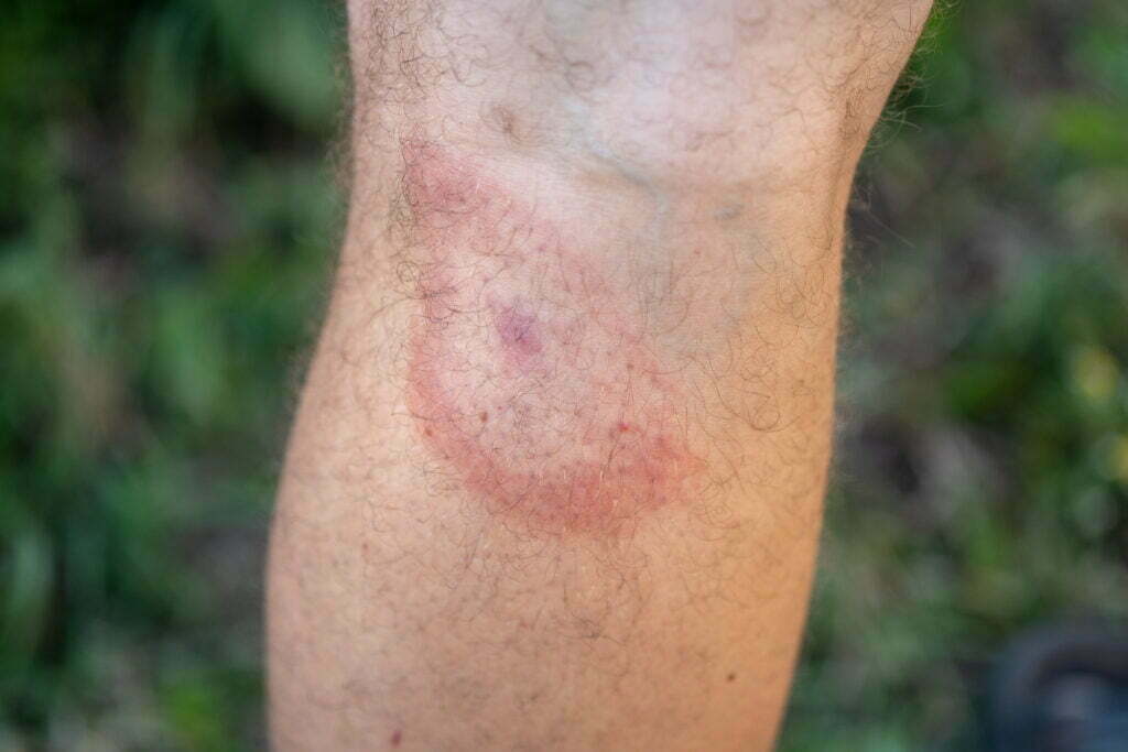 Zeckenbiss am Bein eines Mannes. ein Symptom der durch Zecken übertragenen Borreliose. ein roter Ring in Form einer Zielscheibe am Bein